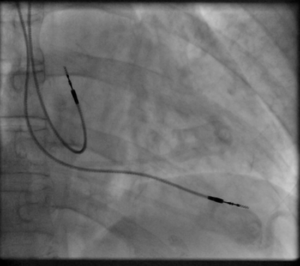 Fluoroscopy_pacemaker