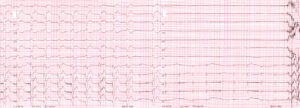 Pacemaker_dependent_asystole